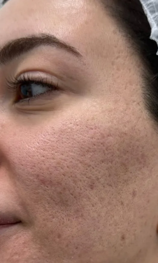 Joue d'une femme avec des cicatrices d'acné avant le Laser Frax chez My Laser Casablanca