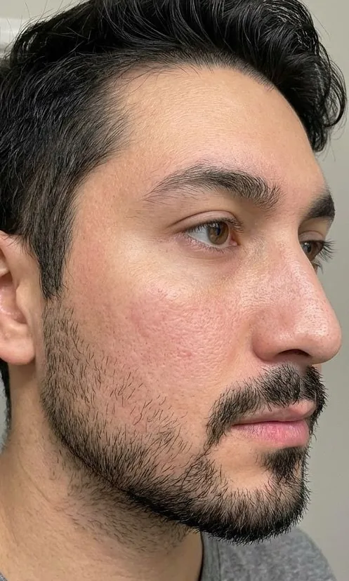 Joue lissée après les séances de Laser Frax chez My Laser Casablanca