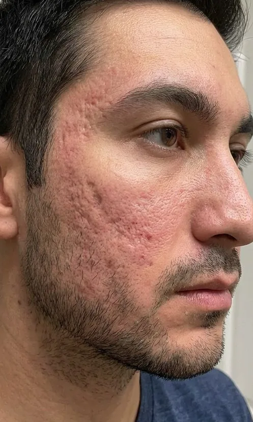Joue d'un homme creusée par des cicatrices d'acné avant le Laser Frax chez My Laser Casablanca